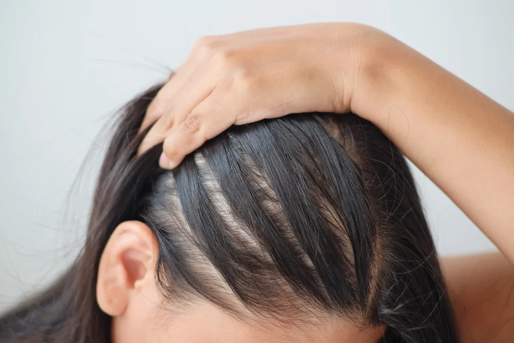 hair-clinic-in-sg-reveals-5-causes-of-hair-loss-in-women